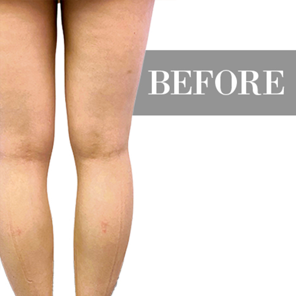 3D Leg Slimming Dr Shun Aesthetic Clinic