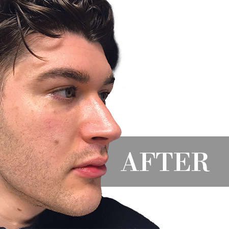 After image
